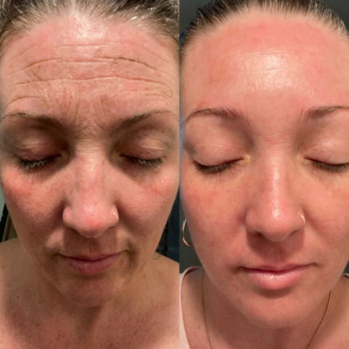 ChewRoutine face and eye tightener customer result